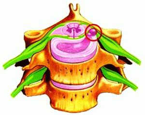 межпозвоночнная грыжа методы лечения