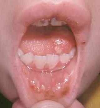 aphthous stomatitis in a child treatment