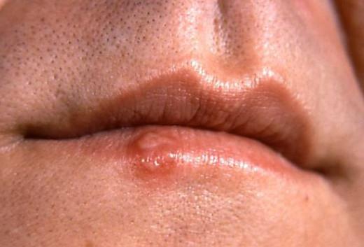 симптомы рака губы