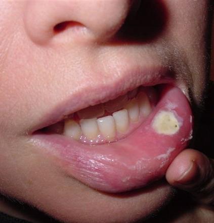 рак верхней губы симптомы