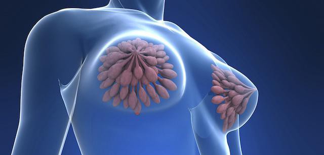 как распознать рак груди 