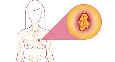 how to detect breast cancer