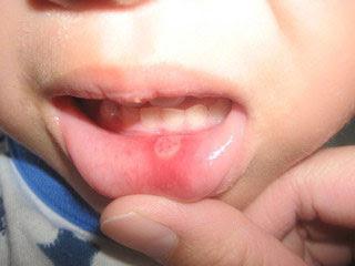 stomatitis in children treatment at home