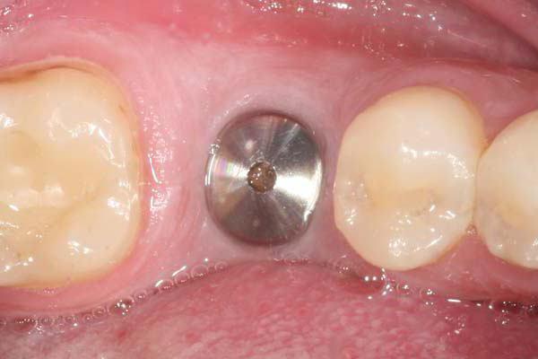 имплантация зубов одномоментно удалением