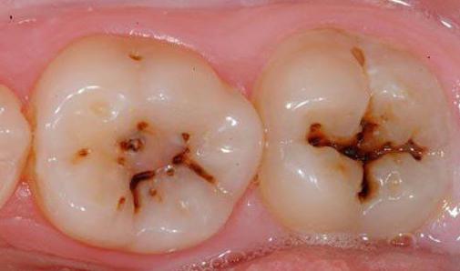 признаки кариеса зубов