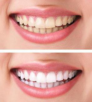 Виды профессиональной чистки зубов противопоказания thumbnail