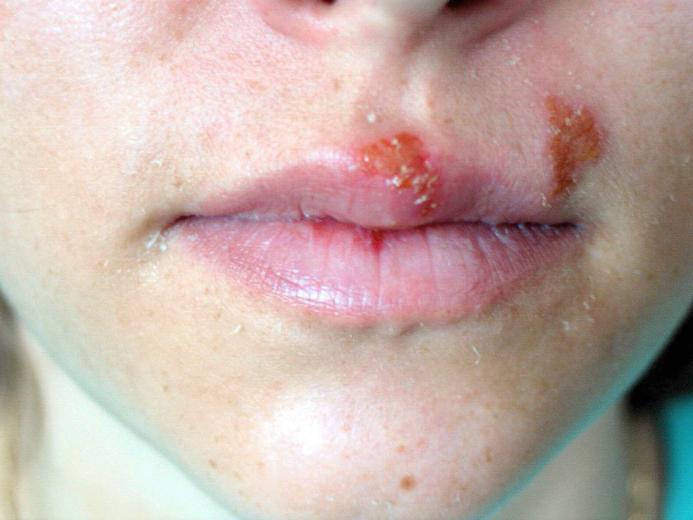 малярия на губах 