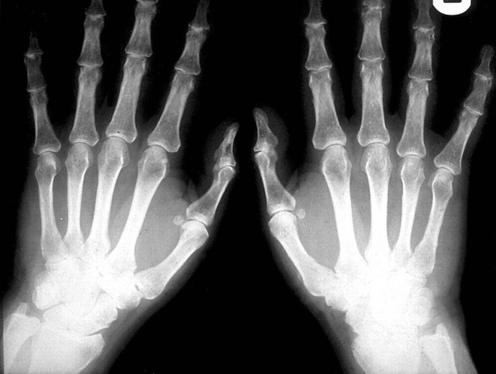 рентген кистей рук