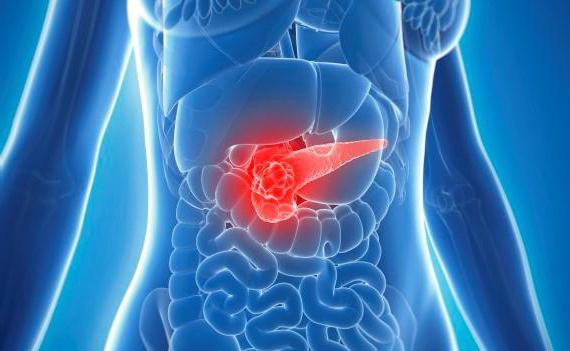 Первые признаки рака желудка и поджелудочной железы на ранней стадии thumbnail