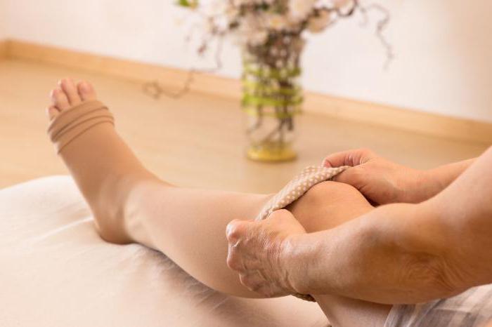 симптомы и лечение варикоза ног у женщин 