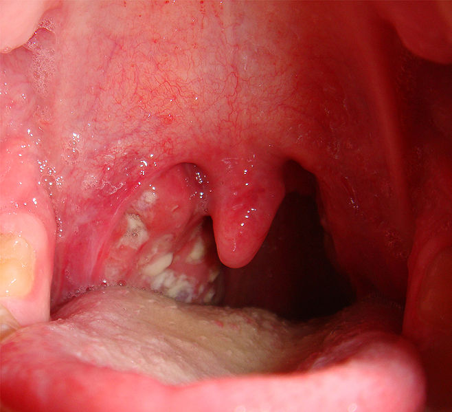 tonsils