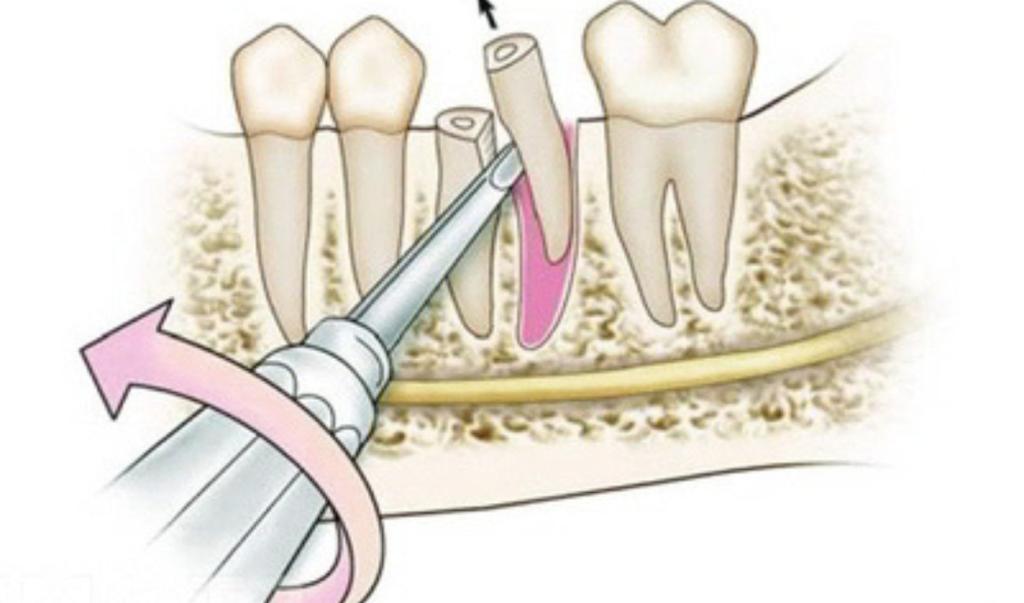 как удаляют корни зубов 