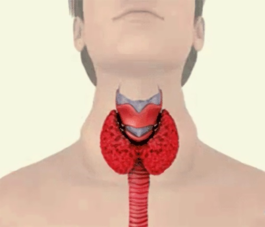 Тиреотоксический зоб. Токсический зоб щитовидка. Тиреотоксикоз щитовидной железы зоб. Тиреотоксический Узловой зоб.
