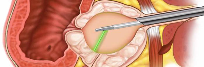 лазерная вапоризация аденомы простаты