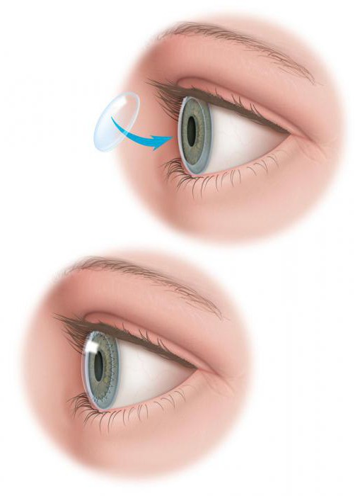 Замена роговицы микрохирургия глаза thumbnail
