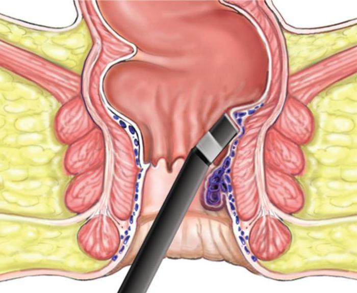 операция геморроя лазером