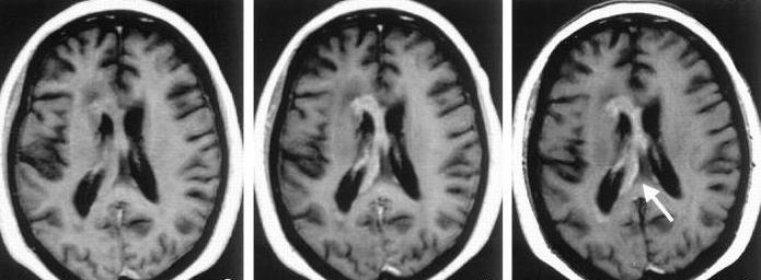 эхоэнцефалография головного мозга у детей
