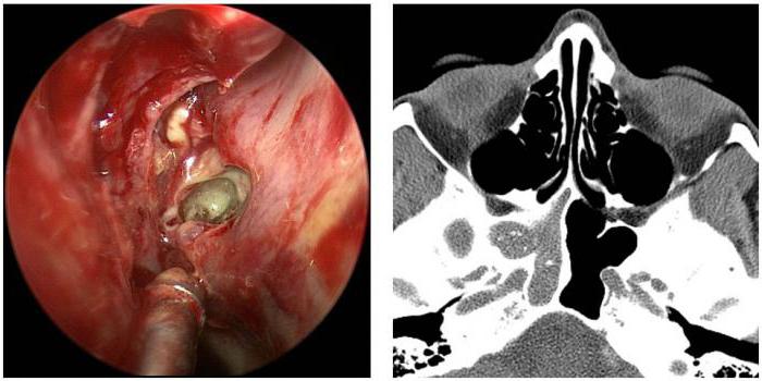 мрт придаточных пазух носа
