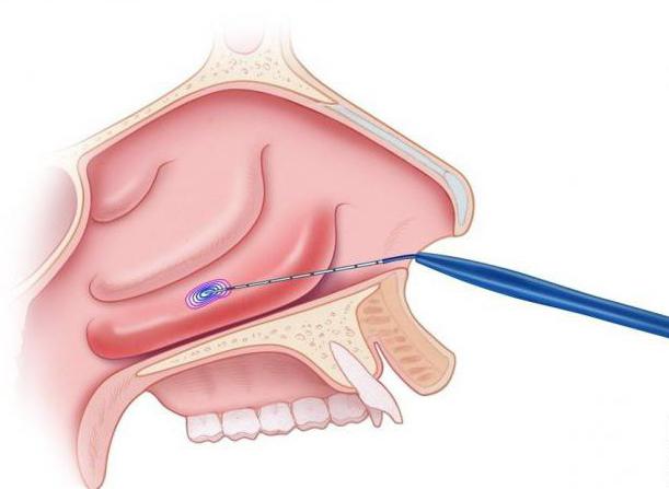 вазотомия нижних носовых раковин отзывы