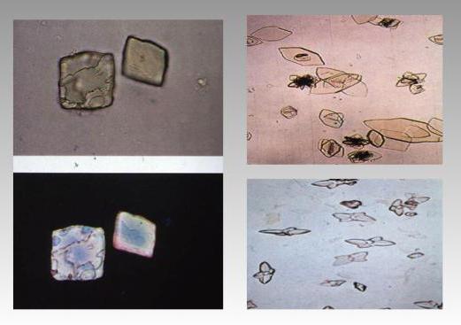 Кристаллы в моче фото и названия