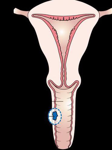 vaginal tumors photo