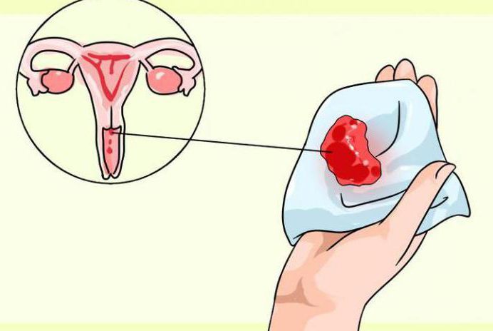 malignant tumors of the vagina