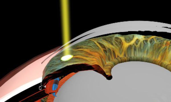 laser iridectomy postoperative period limitation