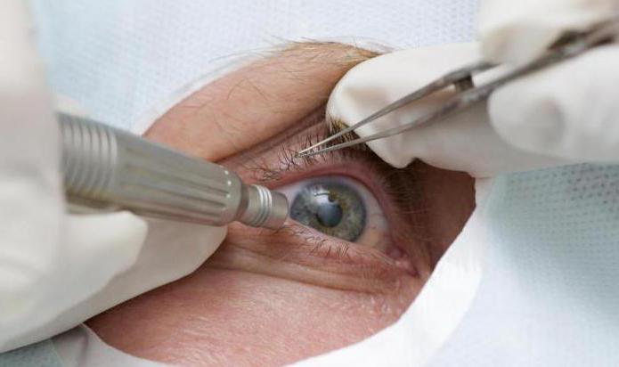 laser iridectomy of the eyes