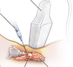 аспирационная пункционная биопсия