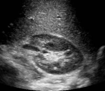 kidney ultrasound