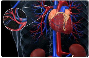 эмболия артерии