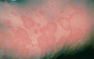 Аллергия на лекарства симптомы у взрослых фото лечение в домашних условиях thumbnail