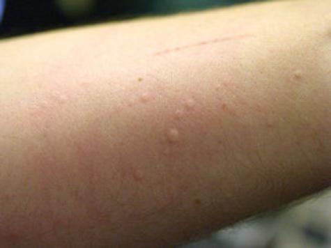 Может ли возникнуть аллергия на препарат если раньше не было thumbnail