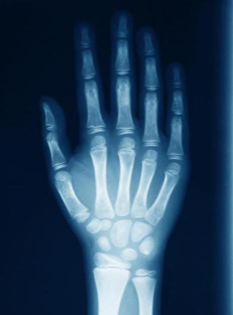 рентген руки 