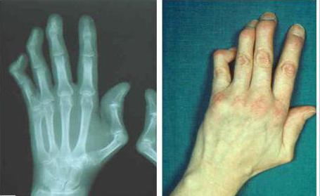 рентген кисти руки 