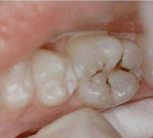 зубной кариес лечение 