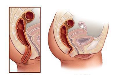 ректальный пролапс фото 