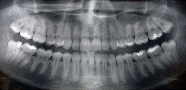 рентген снимок зубов 