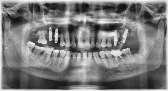 сколько стоит имплантант зуба