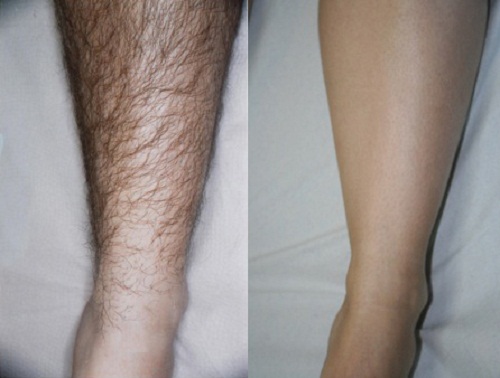 Во сколько лет темнеют волосы на ногах