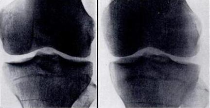 операция на мениске коленного сустава отзывы