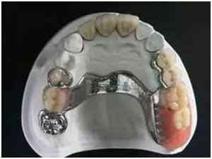 бюгельный протез зубов