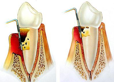 лечение пародонтита в домашних условиях народными средствами
