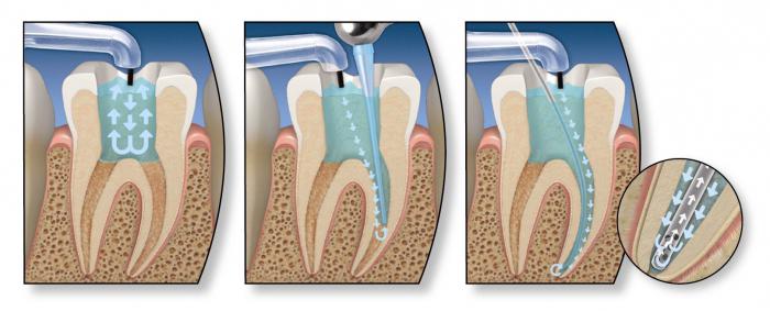 Восстановление стенок зуба перед эндодонтическим лечением thumbnail