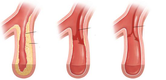 эссенциальная артериальная гипертензия