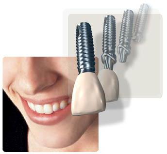 установка зубных имплантов