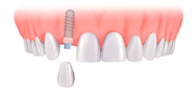 поставить зубные импланты