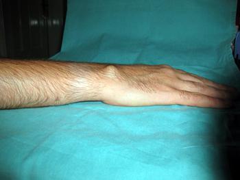 Гигрома на руке лечение