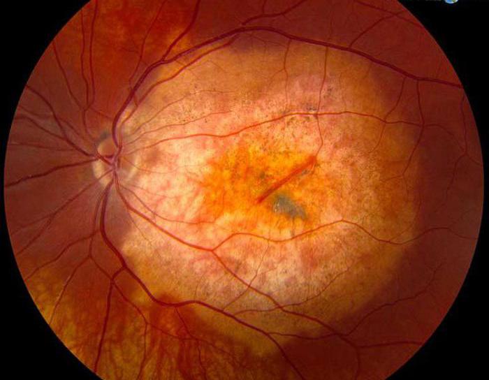 ретинопатия при сахарном