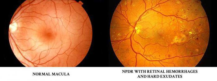 ретинопатия при сахарном диабете